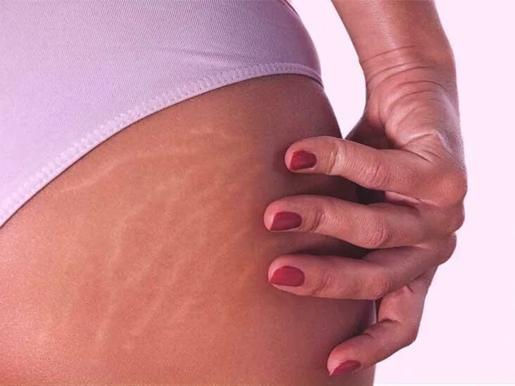 Растяжки stretch marks. Растяжки на ягодицах красные.