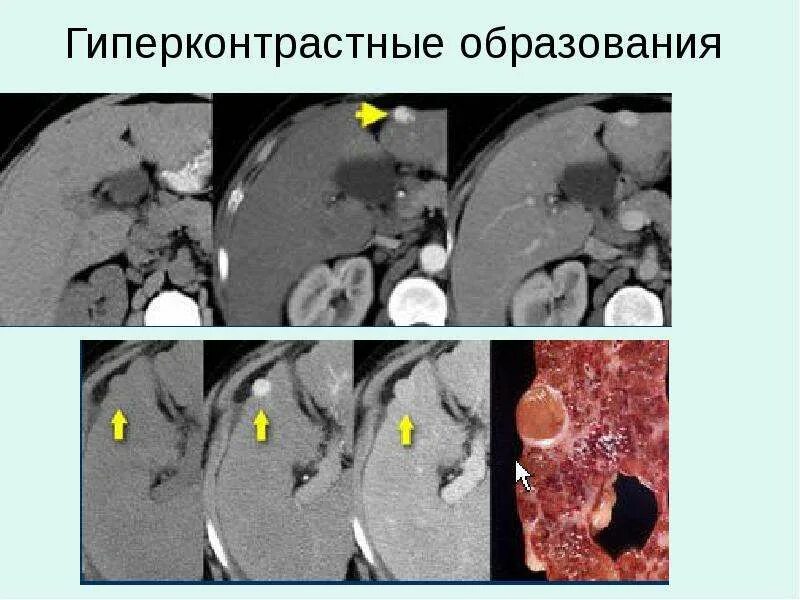 Гиподенсный очаг печени кт. Гиперваскулярные метастазы печени кт. Гиперваскулярные образования печени на кт. Гиповаскулярные образования в печени что это. Округлые образования печени