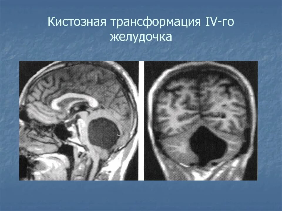 Кистозная трансформация головного мозга кт. Кистозная трансформация 4 желудочка. Кистозная лейкомаляция головного мозга. Кистозная трансформация желудочков головного мозга. Кистозно атрофические изменения головного
