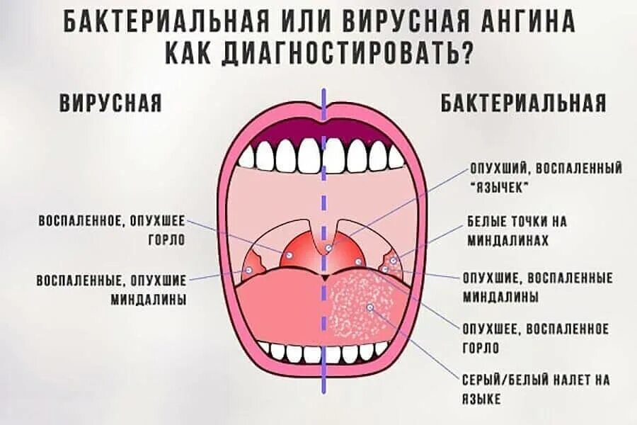 Можно ли во время поста глотать слюну. Виру ная и бактериальеая ангина. Бактеририальная инфекция в норле. Ангина вирусная или бактериальная. Вирусная и бактериальная ангина отличия.