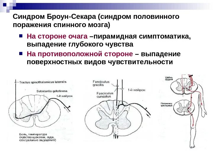 Очаг поражения и симптомы при синдроме Броун-Секара. Синдром половинного поражения спинного мозга Броун Секара. При синдроме Броун-Секара. Половинное поражение поперечника спинного мозга характеризуется.