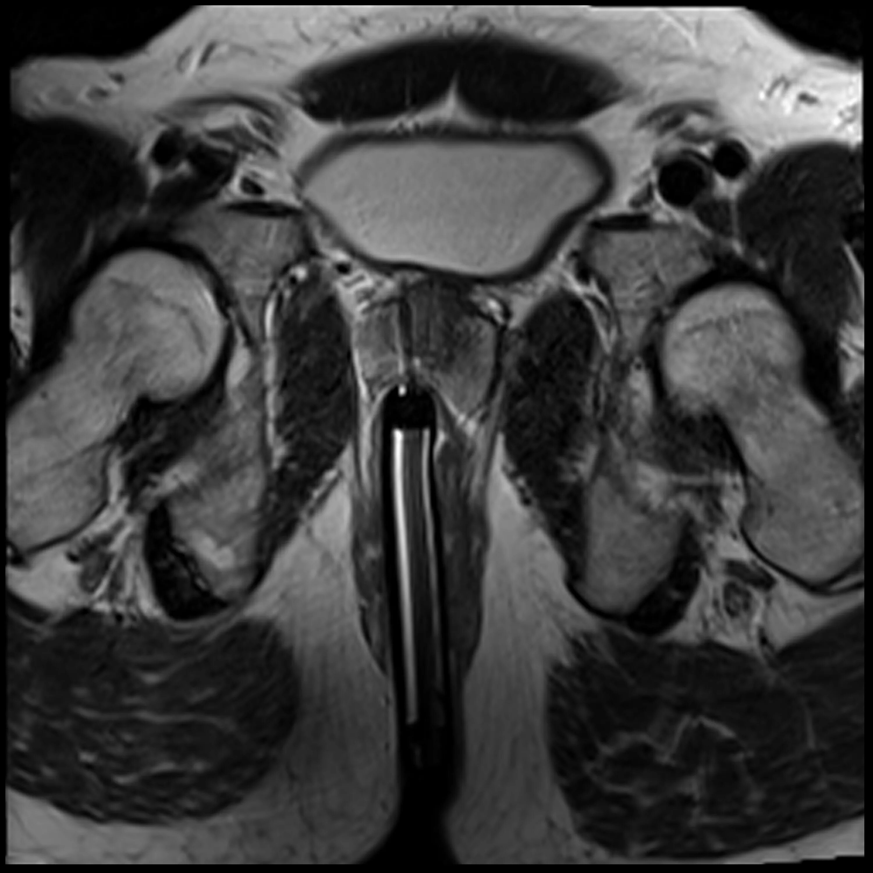 Простата крупный план. Мультипараметрическое мрт простаты. Карцинома мрт предстательной железы. Аденома предстательной железы на кт.