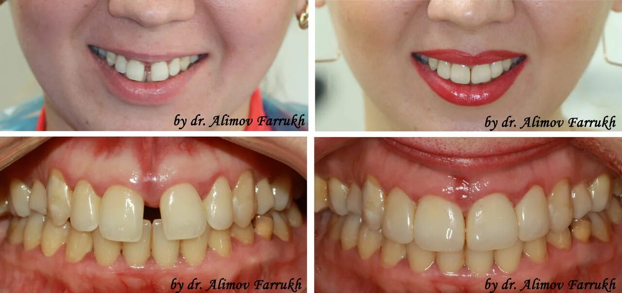 Зубы после 30. Зубы с винирами до и после.