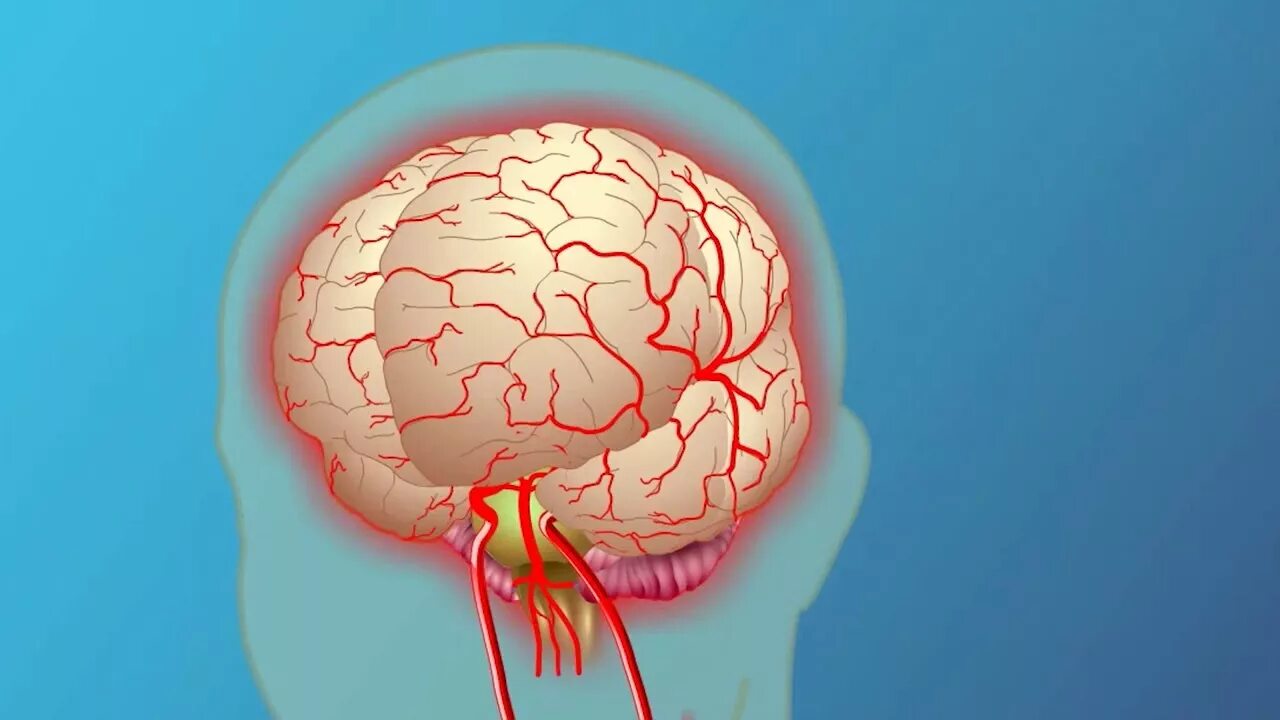 Brain 140. Геморрагический инсульт. Геморрагический инсульт gif. Ишемический инсульт гиф. Поражение головного мозга.