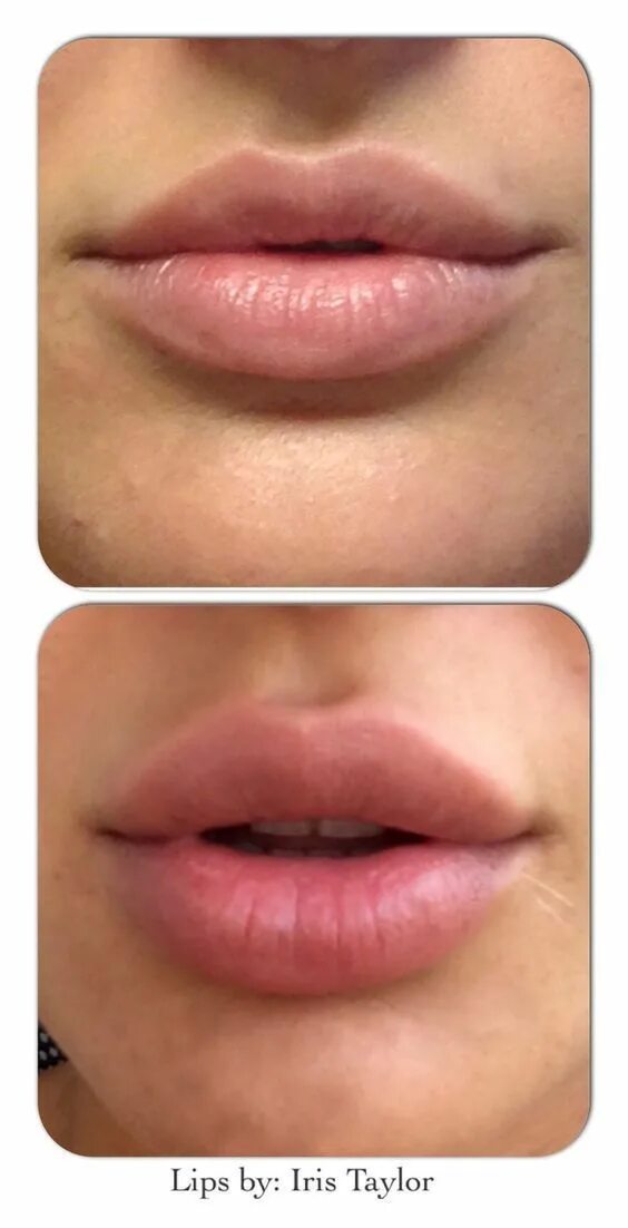Красивое увеличение губ skin expert. Аугментация губ формы губ.