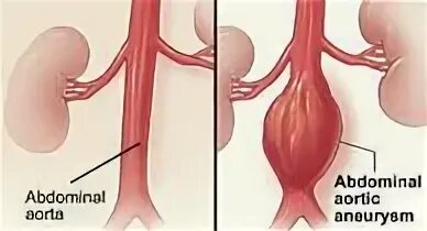 Abdominal aortic aneurysm