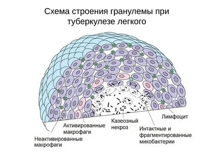 Гранулема туберкулеза