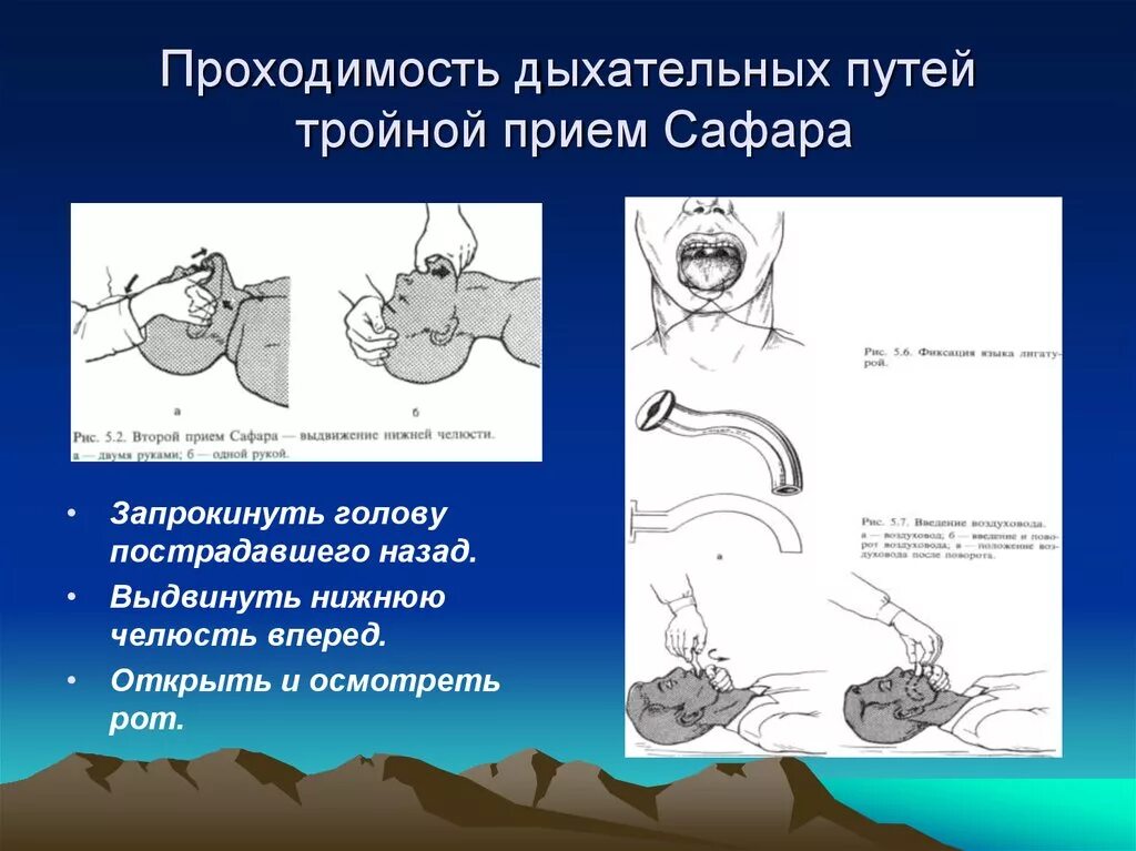 Тройной прием алгоритм. СЛР тройной прием Сафара. Приемы обеспечения проходимости дыхательных путей. Сафара, для обеспечения проходимости дыхательных путей.