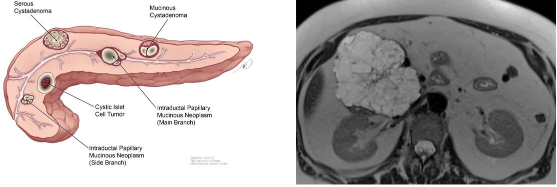 Кальцификация поджелудочной железы кт. Крючковидный отросток поджелудочной железы на кт. Кт картина опухоли поджелудочной железы. Муцинозная опухоль поджелудочной железы на кт. Опухоль в капсуле