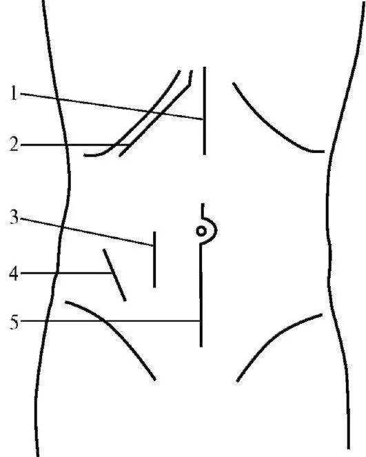 Какое лапаротомия. Верхнесрединная лапаротомия. Срединная лапаротомия операция. Продольные разрезы лапаротомия. Нижнесрединная лапаротомия разрез.