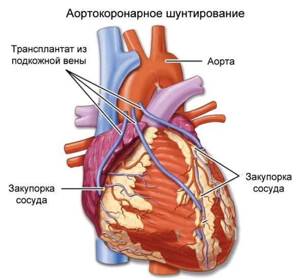 Операция замена сосудов. Коронарное шунтирование сосудов сердца. Аортально коронарное шунтирование. Схема операции аортокоронарного шунтирования. Шунтирование коронарных артерий сердца.