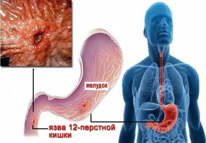 Язва и армия. Язвенная болезнь 12 перстной кишки симптомы. Язвенная болезнь желудка и 12 перстной кишки симптомы. Язвенная болезнь желудка и 12 перстной кишки. Язва желудка и 12 перстной кишки.