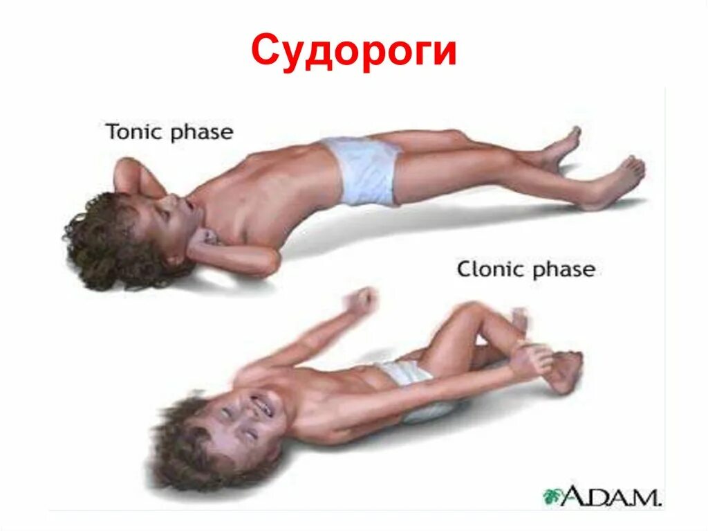 Сильные судороги причина. Судорожный синдром в ногах.