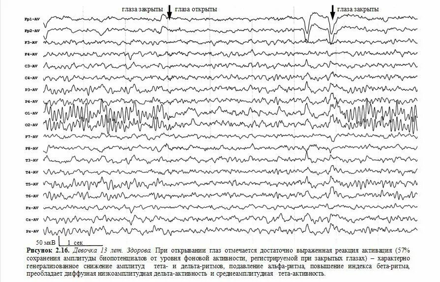 Возрастные нормы Альфа ритма на ЭЭГ. Топографические характеристики ЭЭГ. PZ-a2 ЭЭГ. Реакция активации на ЭЭГ снижена. Ээг глаза