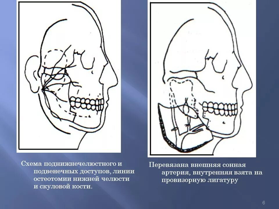 Челюстно лицевая хирургия перелом скуловой кости. Репозиция скуловой кости. Переломы скуловой кости и дуги схемы. Комбинированная травма челюстно лицевой области.