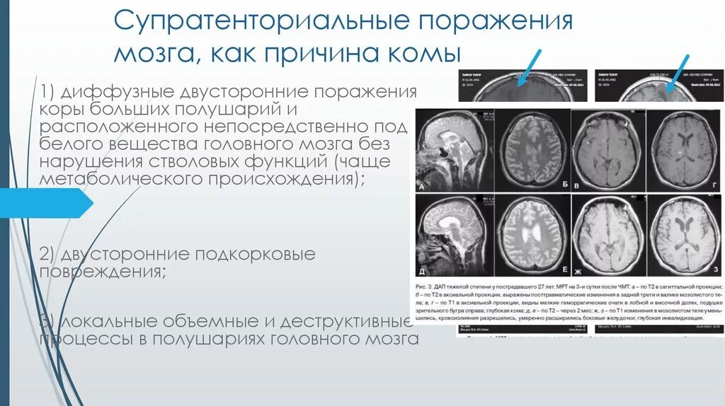 Супратенториальные поражения. Супратенториальные образования головного мозга. Супратенториальные структуры мозга. Супратенториальное поражение мозга. Мозговая кома причины