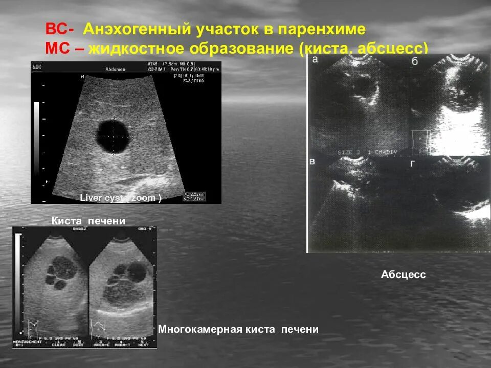 Образование печени киста. Кистозные образования печени анэхогенное. Анэхогенные образования в печени что это такое. Многокамерная киста печени. Жидкостные образования в печени что это.