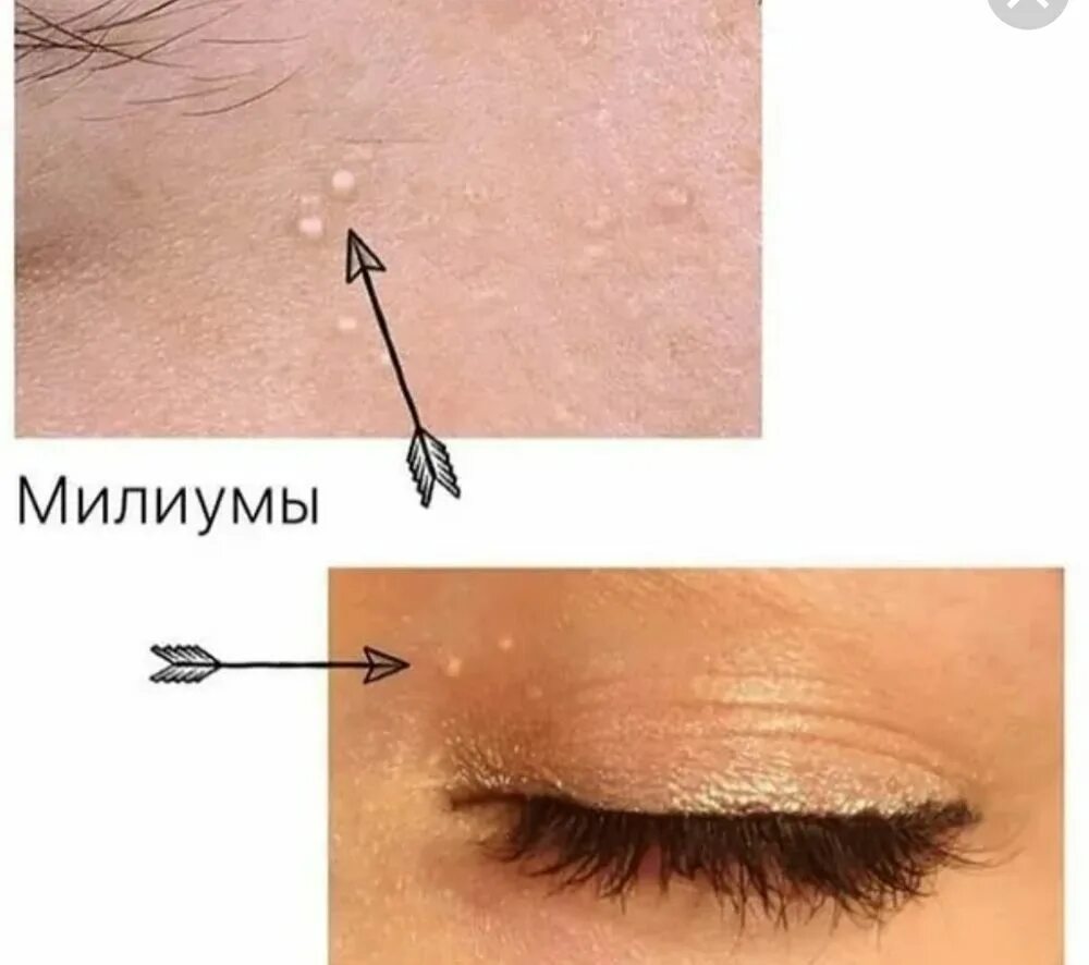 Как выглядят милиумы на лице Удаление милиумов в Минске, цена Лазерное удаление милиумов на лице, под глазами