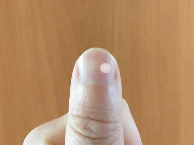 Белые пятна на ногтях приметы. Белые пятна на ногтях приметы. Микотическая лейконихия. Заболевания по ногтям рук. Белое пятно на большом пальце.