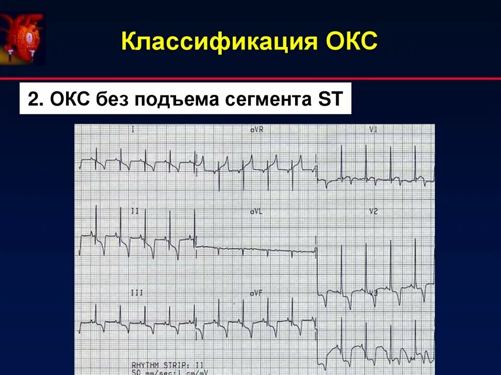 Острый коронарный синдром инфаркт. ЭКГ без подъема сегмента St. Инфаркт миокарда с подъемом сегмента ст ЭКГ. Окс инфаркт ЭКГ. Подъем сегмента St на ЭКГ.