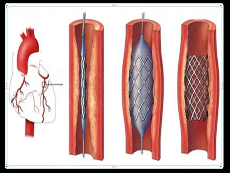 Коронарное стентирование сосудов сердца. Коронарография сосудов стентирование. Лазерная ангиопластика. Операция стентирование сосудов сердца. Операция через сосуды