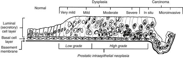 Low grade яичников. Простатическая интраэпителиальная неоплазия предстательной железы. Интраэпителиальная неоплазия Low Grade. Интраэпителиальная неоплазия Low Grade желудка. Ацинарная дисплазия предстательной железы.
