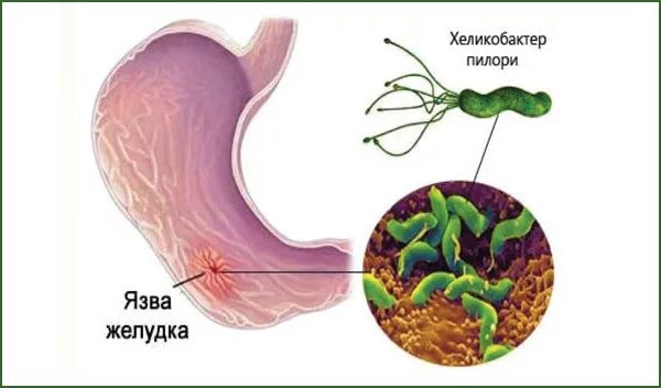 Пилори язва