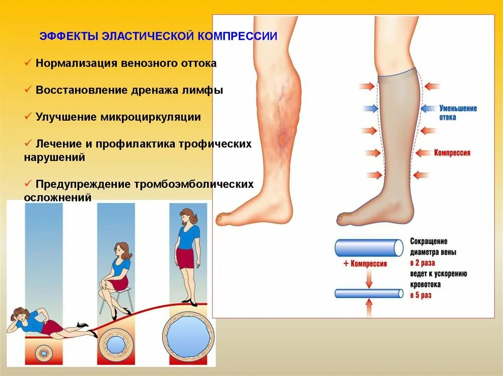 Варикозное расширение вен нижних конечностей трофические язвы. Эластическая компрессия нижних конечностей. Трофические изменения голени. Профилактика лечения тромбов