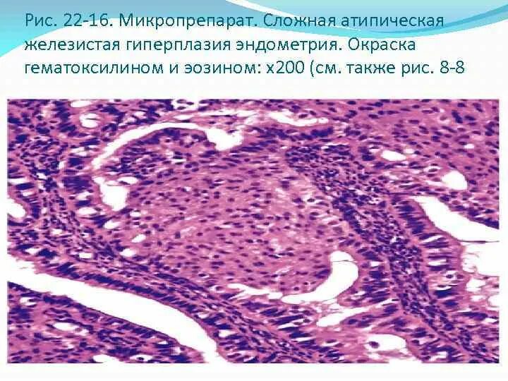 Простая гиперплазия эндометрия гистология. Гиперплазия эндометрия с атипией гистология. Неатипическая железистая гиперплазия. Железисто-кистозная гиперплазия гистология. Простая железистая гиперплазия эндометрия