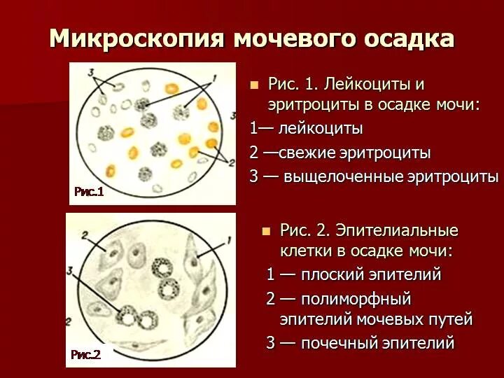 Почему повышенный эритроциты в моче. Лейкоциты в моче микроскопия. Микроскопия мочи норма микроскопия осадка. Эритроциты примикроскопии осдка мочи. Лейкоциты и эритроциты в моче микроскопия.