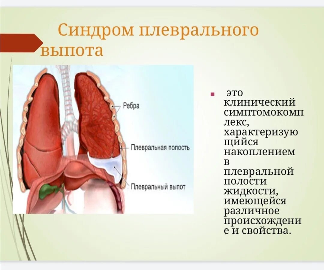 Плевральные осложнения. Синдром плеврального выпота. Виды плеврального выпота. Плевральный выпот лечение. Плевральный выпот клинические рекомендации.