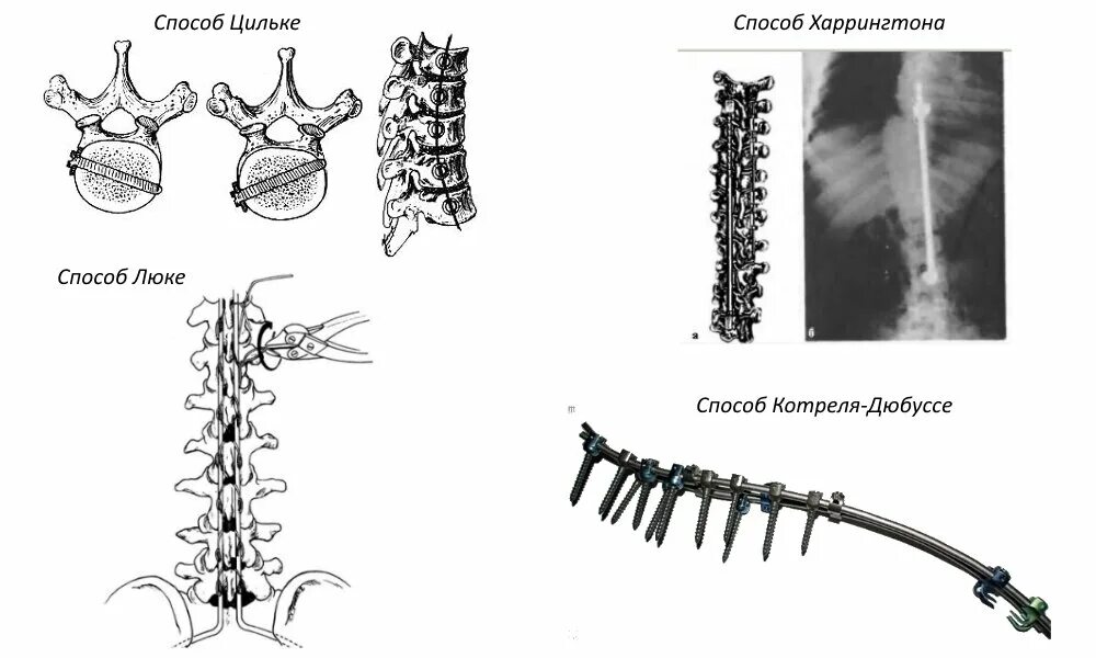 Оперативное лечение позвоночника. Операция Харрингтона сколиоз. Операции сколиоз поясничный отдел. Дистрактор Харрингтона при сколиозе. Метод Харрингтона сколиоз.