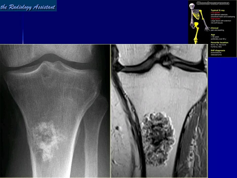 Степени саркомы. Хондросаркома метастазы. Хондросаркома плечевой кости на кт. Энхондрома большеберцовой кости. Энхондрома бедренной кости.