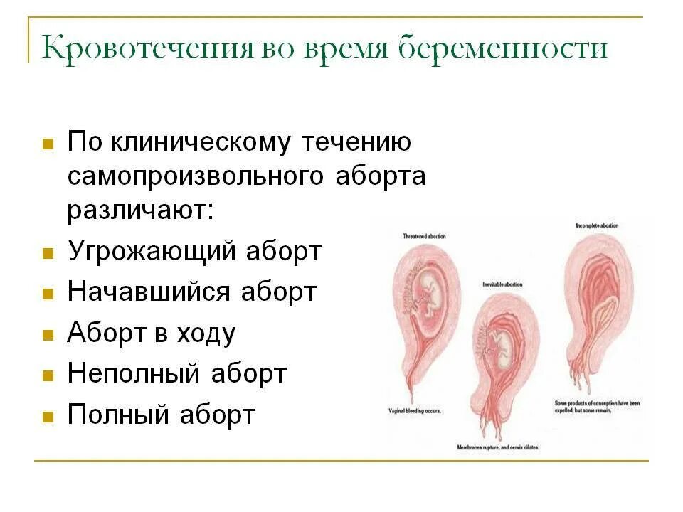 Причины крови во время акта. Сохранение беременности на ранних сроках при кровотечении. Кровотечение во время беременности. Начавшийся самопроизвольный выкидыш. Угрожающий аборт аборт в ходу.