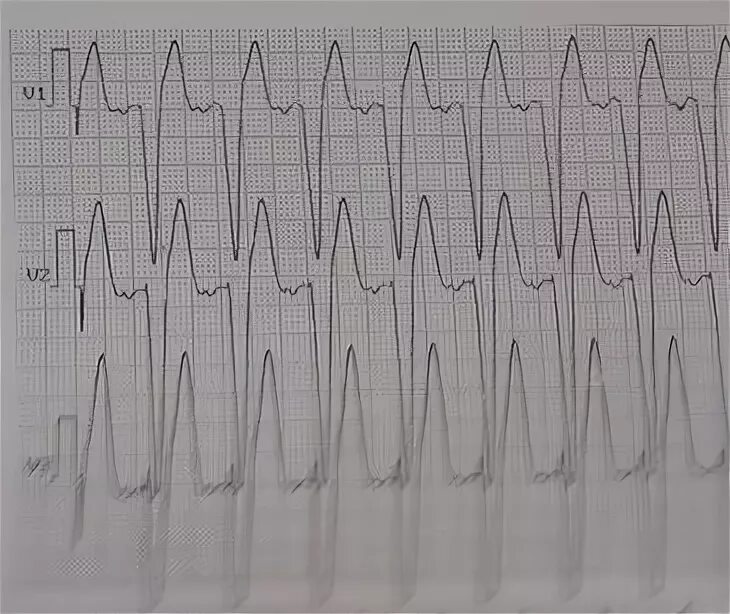 Синусовая тахисистолия ЭКГ. Элевация сегмента St на ЭКГ. Тахисистолия желудочков на ЭКГ. Брадисистолия.