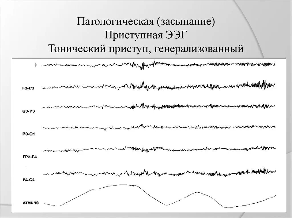 Ээг 9. ЭЭГ при эпилептическом припадке. Брешь ритм на ЭЭГ. Приступ эпилепсии на ЭЭГ. Изолиния на ЭЭГ.