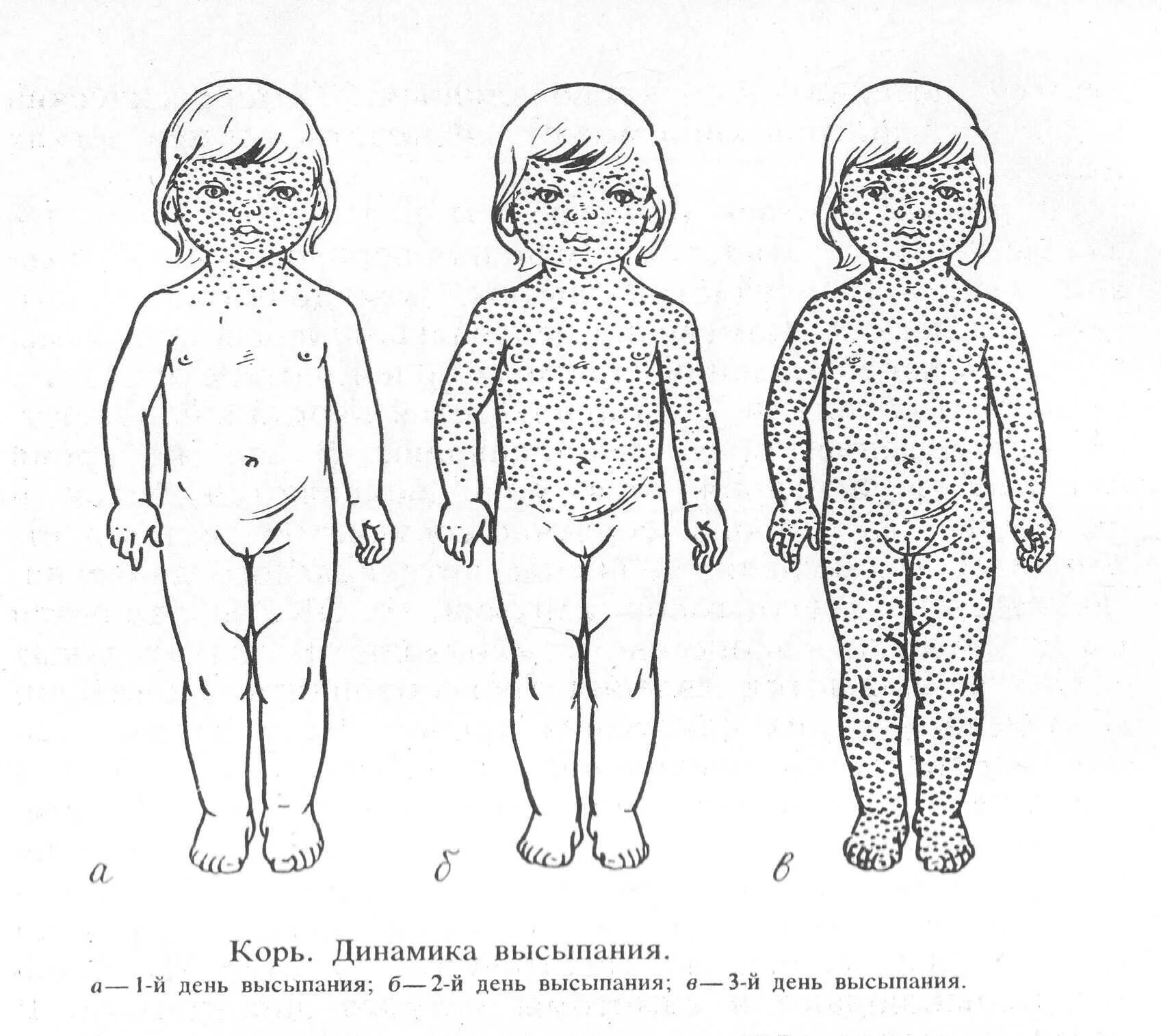 Ветренреная оспа. Аллергические заболевания у детей. Орви легкой степени. Аллергические заболевания у детей. Проявление туберкулеза.