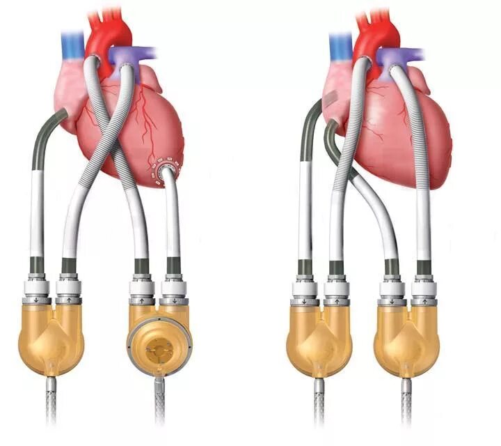 Искусственный левый желудочек сердца. Искусственный левый желудочек сердца HEARTMATE II. Аппарат искусственного кровообращения Thoratec.. Искусственный левый желудочек сердца Heart made 3.
