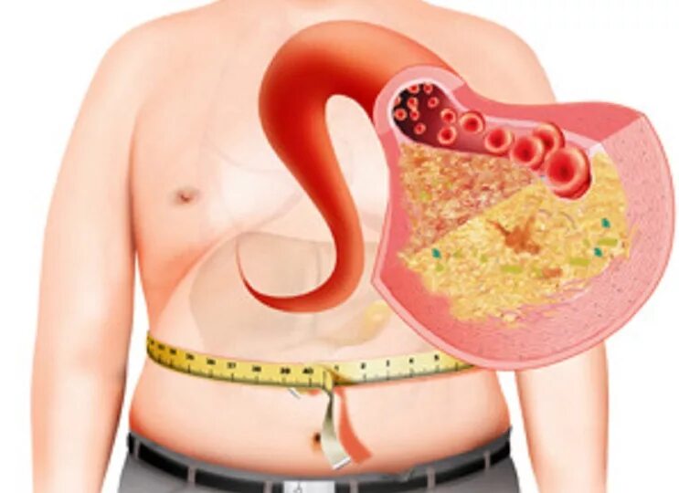 Желчный ожирение. Жировой гепатоз симптомы. Жировой гепатоз и ожирение печени.