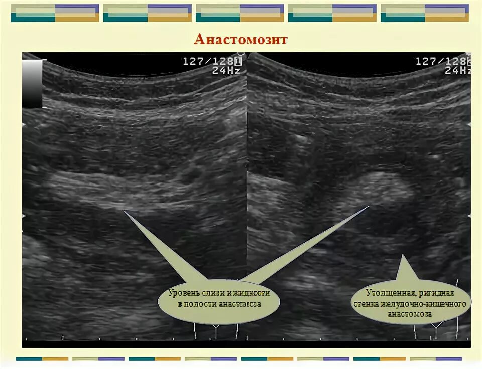 Анастомозит что это. Угол Гиса УЗИ. Поражение полого органа на УЗИ. Симптом пораженного полого органа на УЗИ.