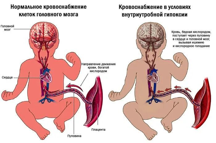 Гипоксия как распознать. Острая внутриутробная асфиксия плода. гипоксия головного мозга патогенез. последствия гипоксии у ребенка.