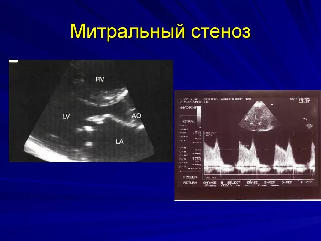 Эхокг при митральной недостаточности. Митральный клапан на эхокг. Пролапс митрального клапана на эхокг. Пролапс митрального клапана 1 степени на узи. Митральный клапан на эхокг.