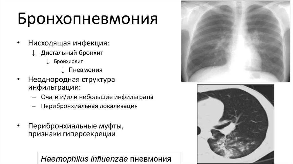 Пневмония признаки у взрослых. Бронхопневмония у детей рентген. Правосторонняя бронхопневмония рентген. Бронхопневмония и бронхиолит на кт. Бронхопневмония рентген протокол описания.