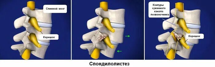 Смещение в поясничном отделе. Спондилолистез позвоночника. смещение позвонка. сместился позвонок в пояснице. смещение позвонка в поясничном отделе.