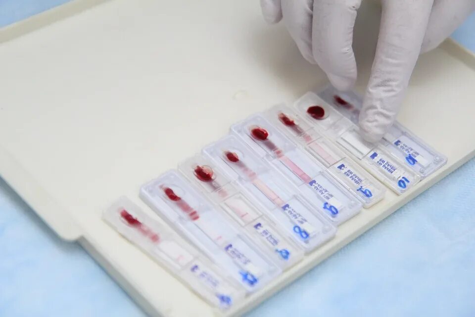 Тест на вич и спид. Экспресс-тест на ВИЧ-1/2. Тест-полоски на ВИЧ ISCREEN-HIV (1&2). Экспресс тест на ВИЧ кровь. Экспресс тест на ВИЧ кровь из пальца.