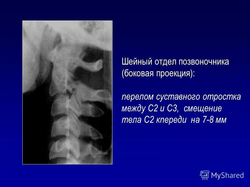 Перелом тел позвонков мкб. Шейный отдел позвоночника боковая проекция. рентген шейного отдела позвоночника сбоку. перелом шейных позвонков рентген. шейный отдел позвоночника рентген боковая проекция.