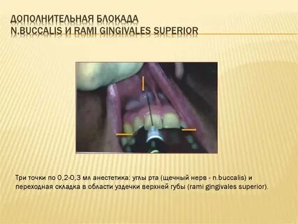 Переходная складка слизистой оболочки