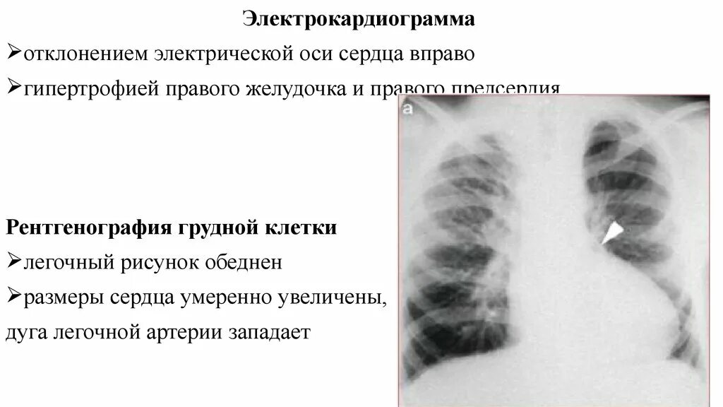 Рентген при гипертрофии правого желудочка. Гипертрофия левого желудочка рентген заключение. Рентген признаки гипертрофии правого желудочка. Гипертрофия правого предсердия на рентгенограмме.