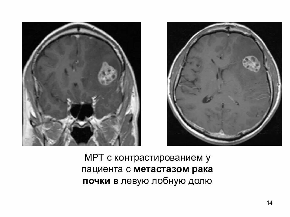 Метастазы в почках