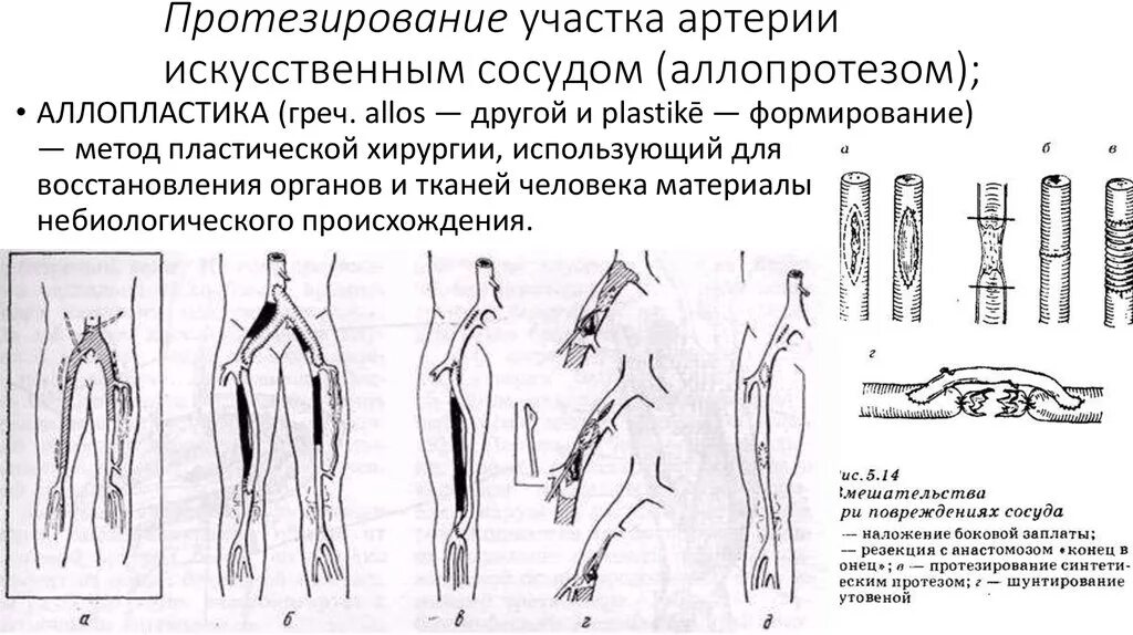 Операция на артерии нижних конечностей